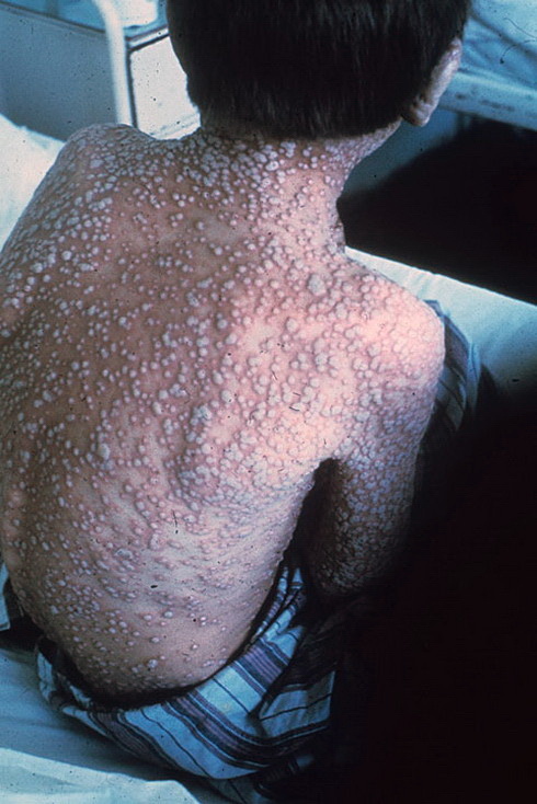 Ребенок больной оспой