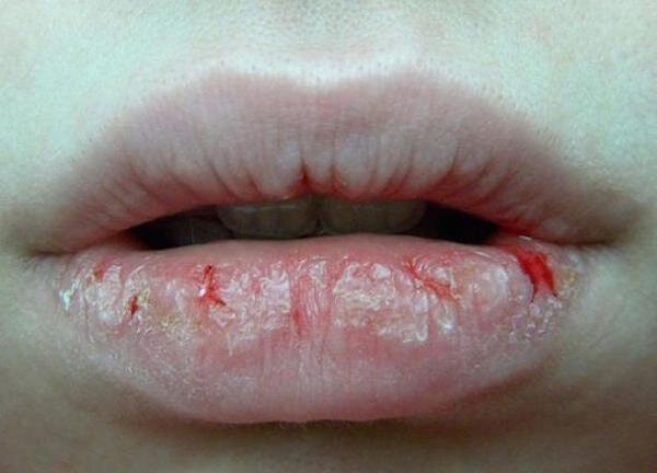 Как избежать трещин на губах