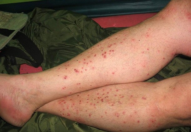 Так выглядят блошиные укусы на ногах человека.