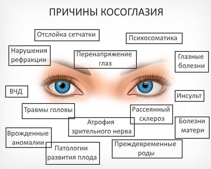 Что это: «ленивый глаз» или косоглазие?