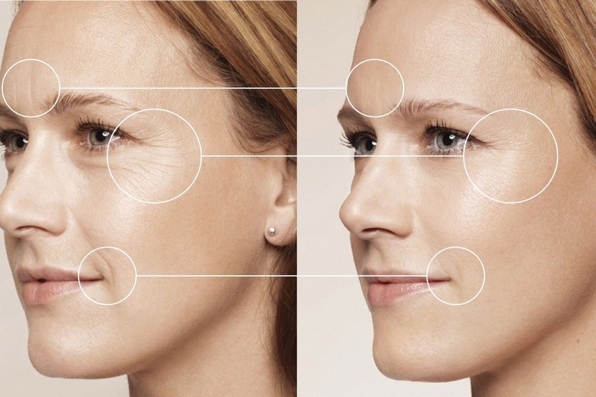 Аутологичными филерами корректируют скулы, компенсируют провисание щек