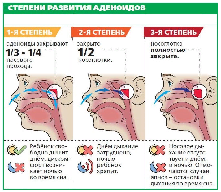 Картинка из открытых источников. Красная штучка в кружочке - это аденоиды (маленькие, средние, большие).