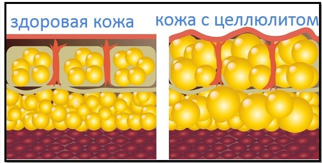пример здоровых жировых клеток и патологии