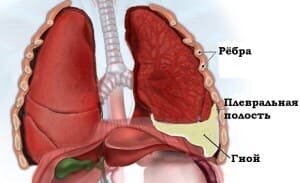 Пневмония: симптомы и лечение