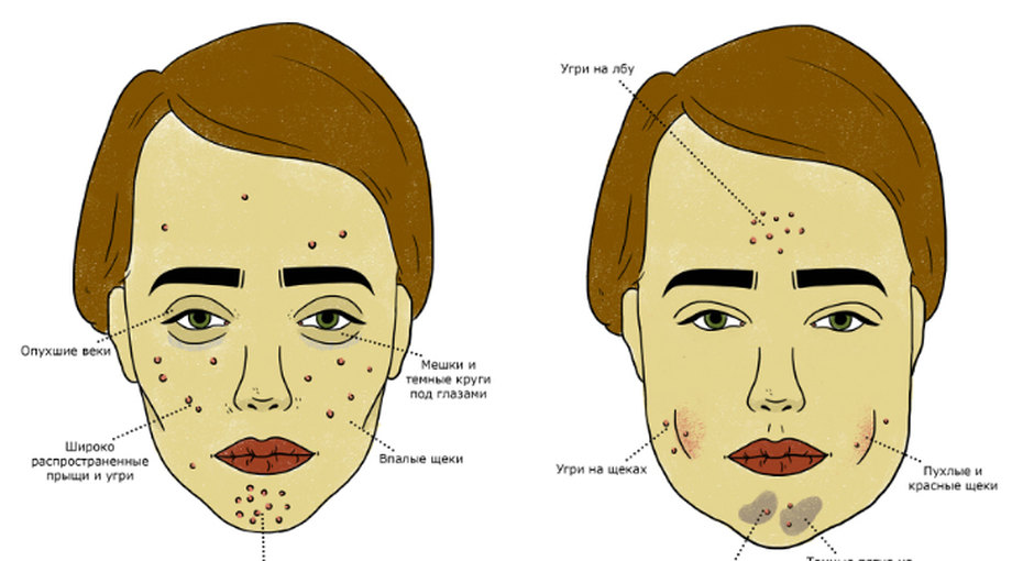 Что означают прыщи зоны. Схема прыщей на лице. Прыщи на лице причины. Типы угревой сыпи на лице. Карта прыщей на лице.