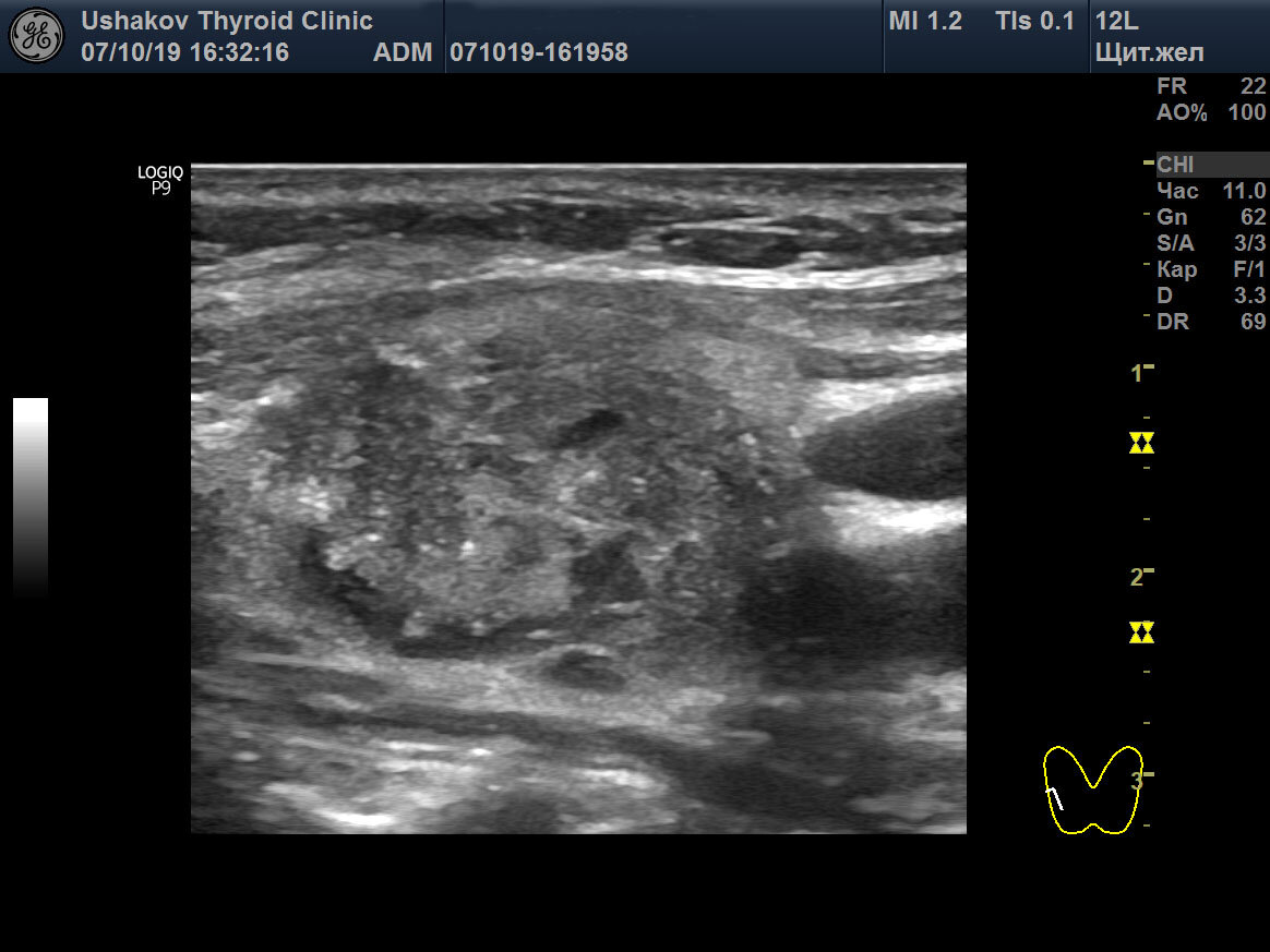 Медуллярный рак щитовидной железы на узи фото