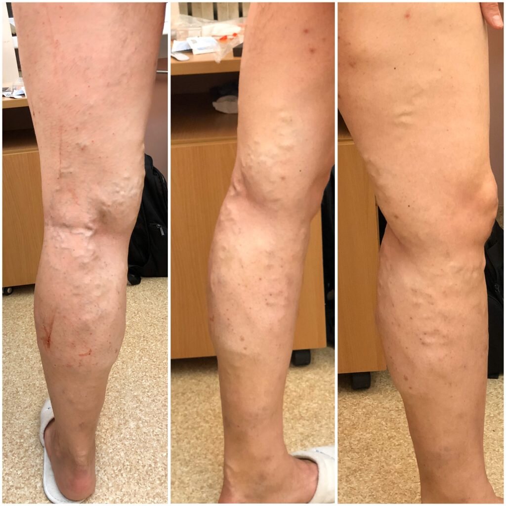 До операции. Ногу кое-как побрил бритвой, порезался раз пять