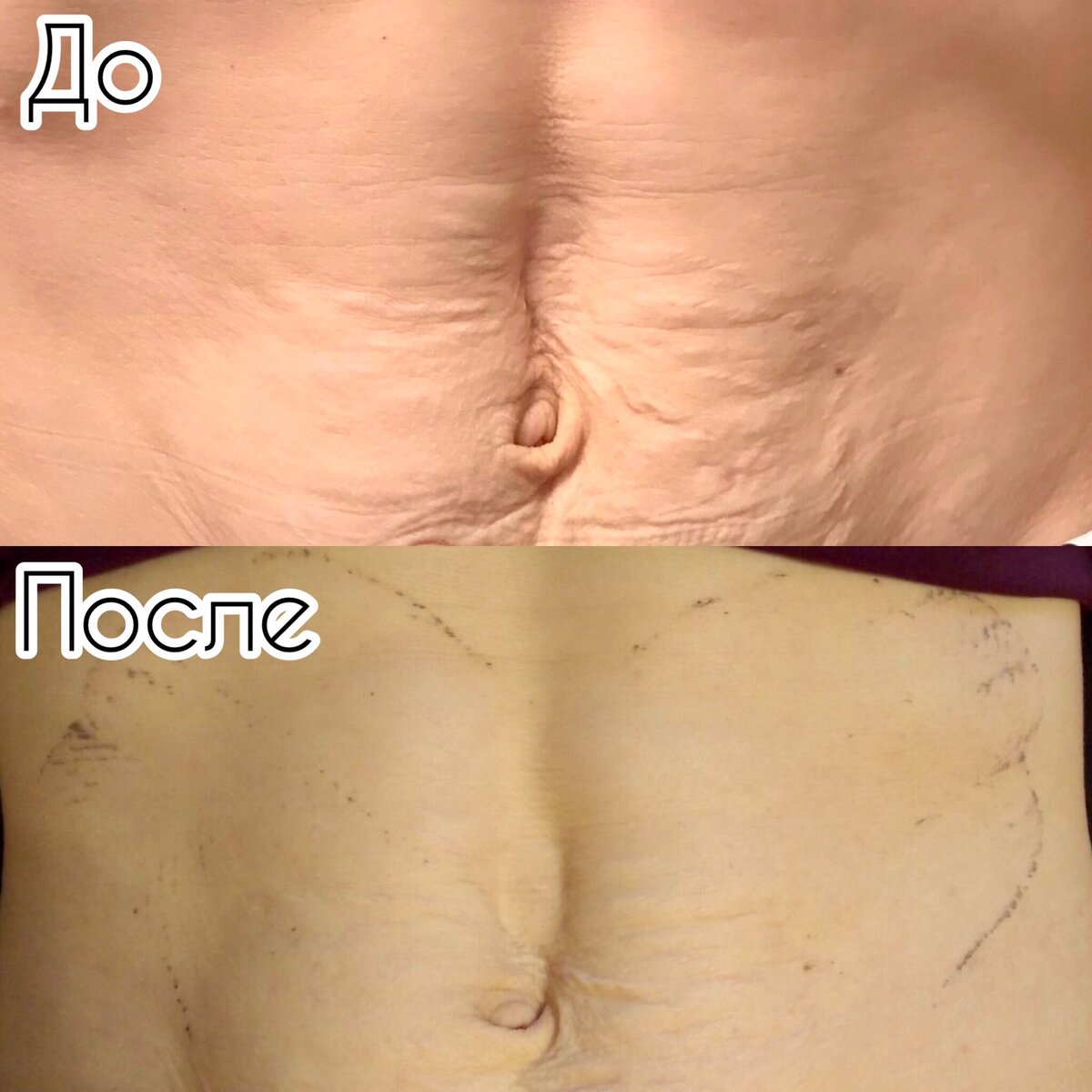 результат после одного ношения