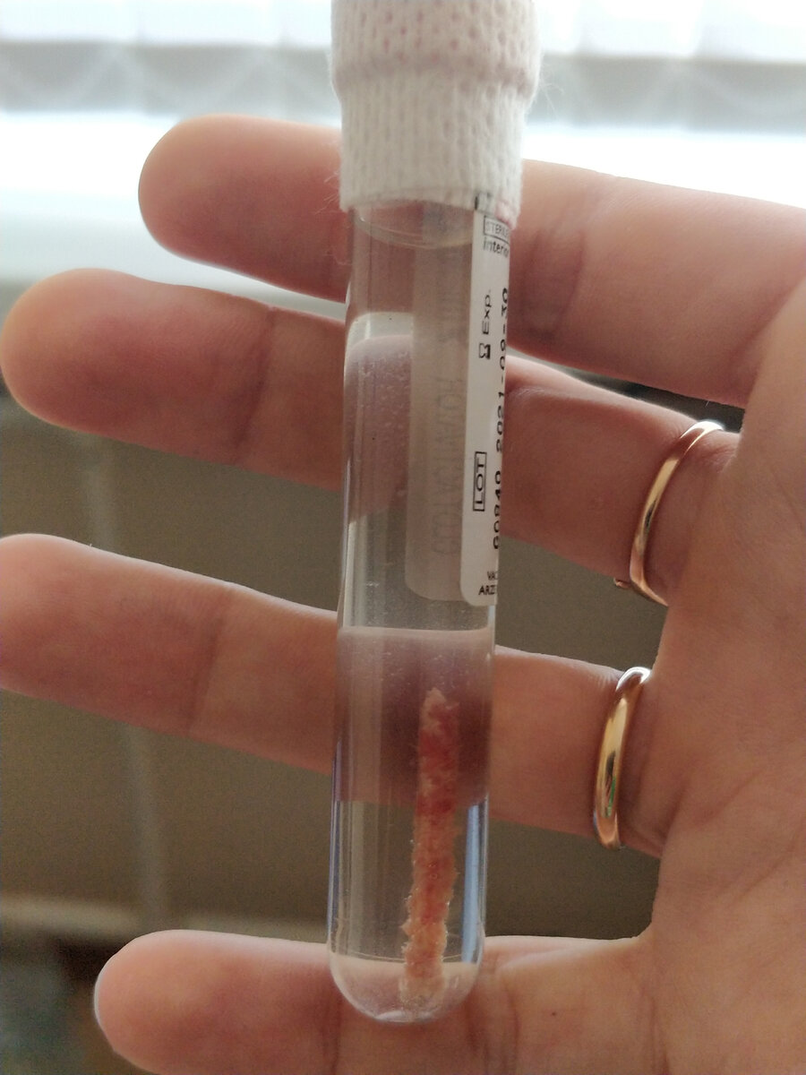 Биоматериал, взятый на трепанобиопсии (кусочек вырезан из кости)