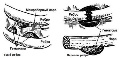  Гематомы при переломе и ушибе ребер