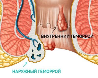 Геморрой при беременности — лечение и профилактика