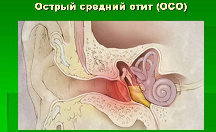 У ребенка на море заболело ухо или появилась боль после бассейна: что делать и к