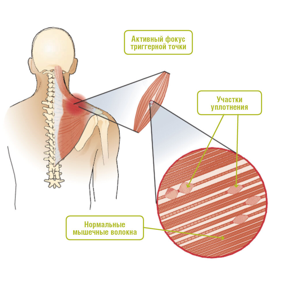 Участки уплотнения и есть те самые болезненны триггерные точки
