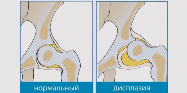 Дисплазия тазобедренных суставов у детей