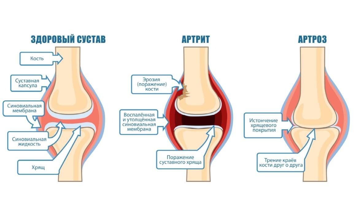 Артрит суставов признаки лечение. Артрит и артроз различия. Отличие артрита от артроза.