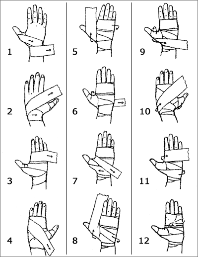На рисунке изображен “простой” способ бинтования рук.