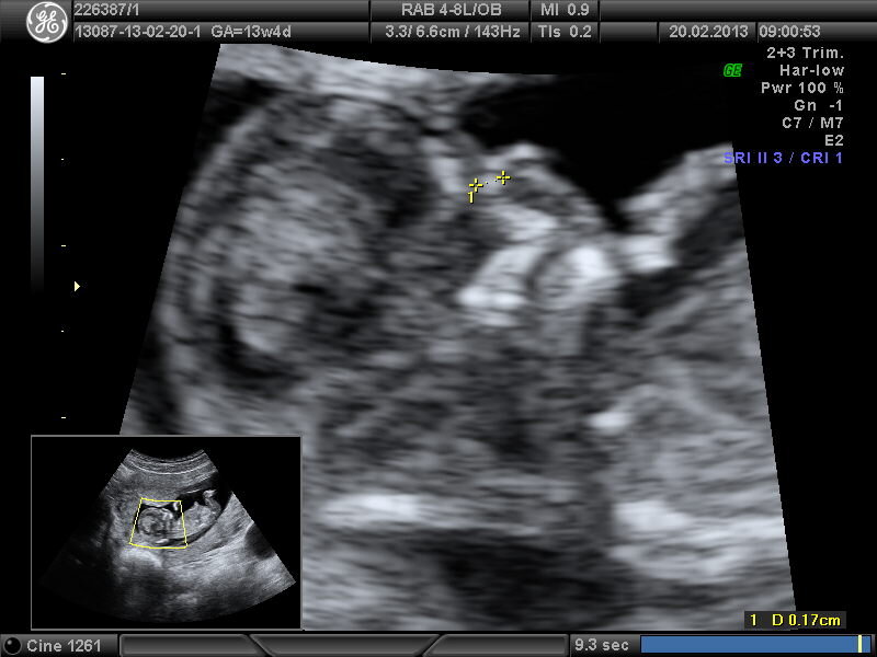 нос на первом скрининге