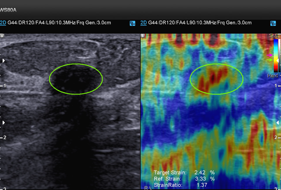 Эластография молочных желез что это. Ультразвуковая компрессионная эластография. Соноэластография ультразвуковая эластография. УЗИ молочных желез эластография. Эластография сдвиговой волны.