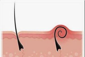 Частое скрабирование. Кожу не нужно слишком часто подвергать пилингу, так как вследствие регенерации она  утолщается, и новые волосы не могут через нее прорасти наружу.