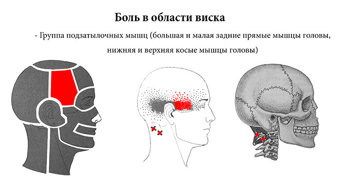 Сдавливающая боль в висках: причины возникновения и тактика лечения