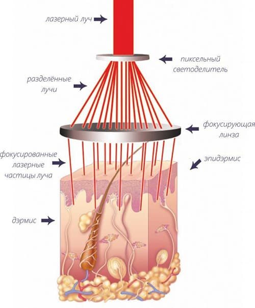 При фракционном фототермолизе под воздействием специального аппарата создаются микротермальные лечебные зоны, в которых активируются самые важные процессы для омоложения