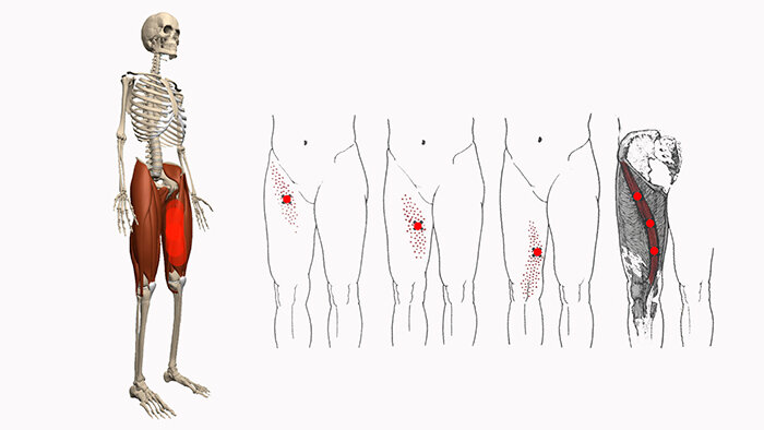 Болит внутреннее бедро. Триггерные точки портняжная мышца. Триггерные точки бедра.