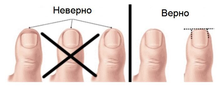 Что делать с вросшим ногтем на ноге: простые домашние рецепты, которые тебе помогут