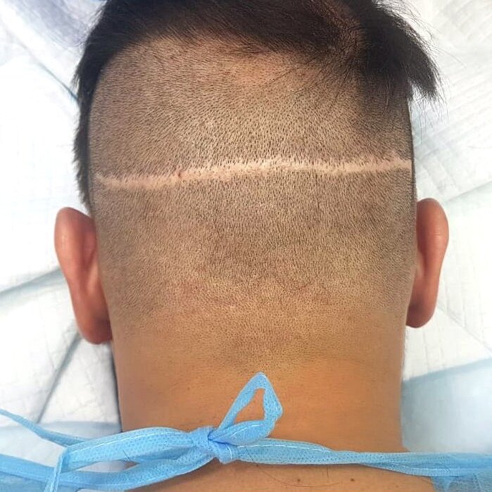 Последствия пересадки волос СТРИП-методом