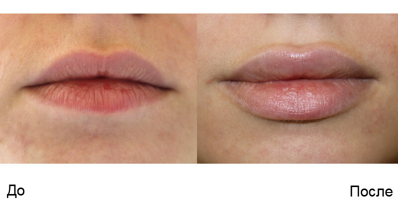 1 мм в губы до и после фото