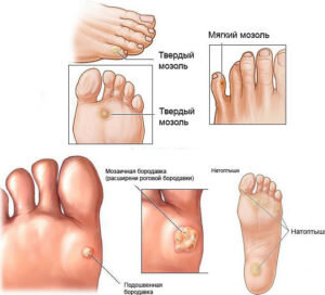Обработка бородавок на ногах