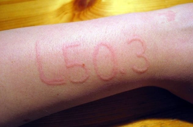 Дермографизм - аллергия на прикосновение

Реакцией, которая есть только у четырех процентов населения, аллергия на прикосновение. Это звучит дико, но вы, вероятно, уже видели эффекты этого раньше.
