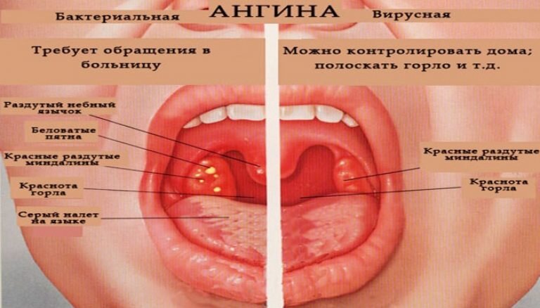 Спиртовой или водочный компресс на горло