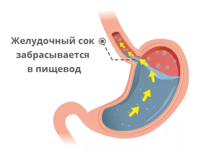 Желудочным содержимым. Билиарный желчный рефлюкс. Билиарный рефлюкс гастрит клинические рекомендации. Дуодено-гастральный рефлюкс желчи