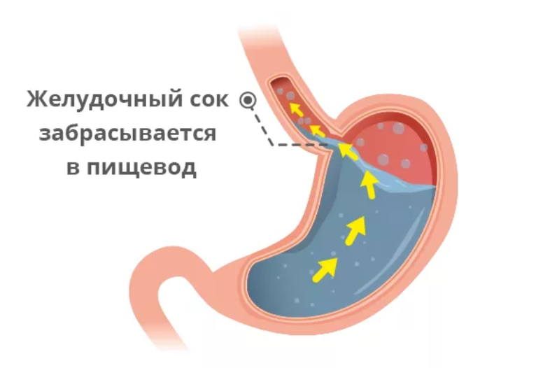 Желудочный сок в пищеводе