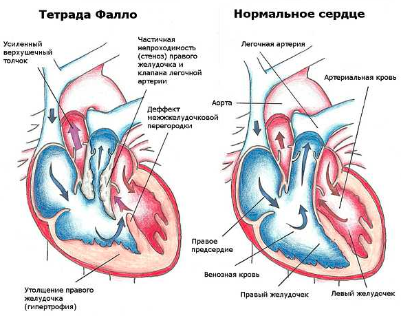Тетрада Фалло в сравнении с нормальным сердцем