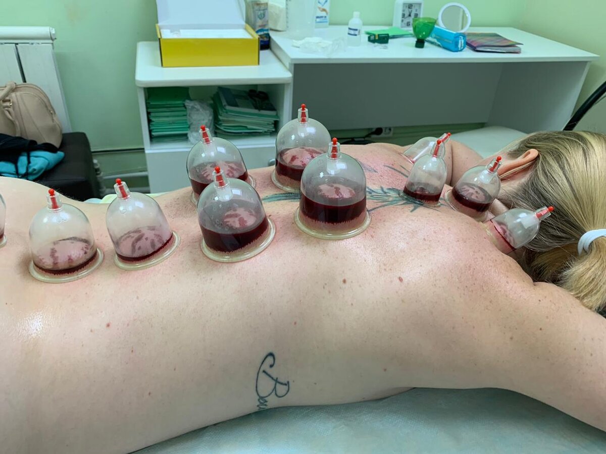 Техника хиджама