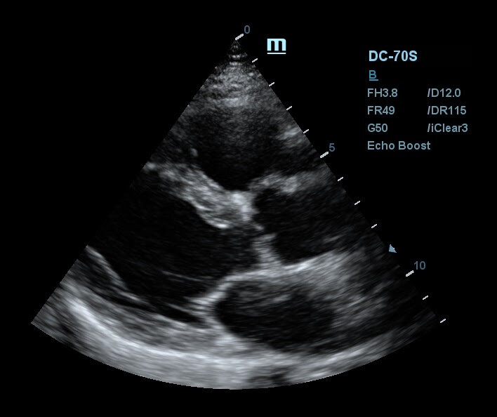 Снимок УЗИ аппарата Mindray DC-70s c использованием технологий iClear и EchoBoost