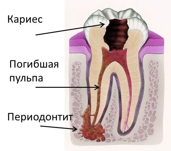 А это схематичное изображение периодонтита