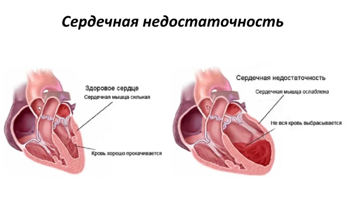 Заболевание сердца сопровождающееся сердечной недостаточностью. Острая хроническая недостаточность сердца. Сердце человека с сердечной недостаточностью. Сесердечная недостаточность это. Сердечная недостаточно.