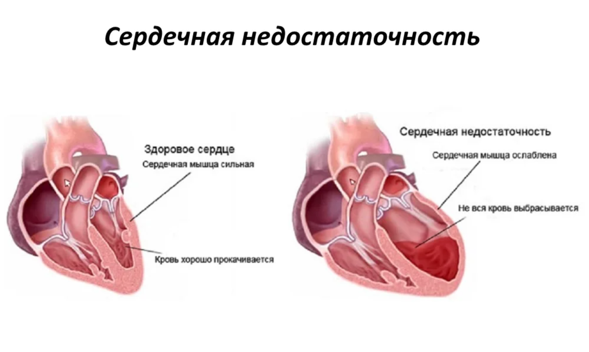 Как снять сердечную недостаточность