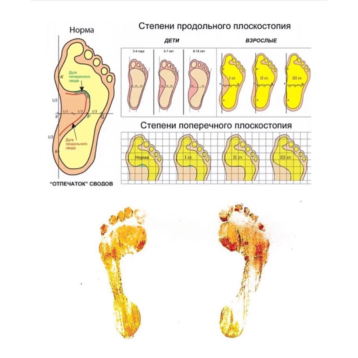 3 степень плоскостопия градусы