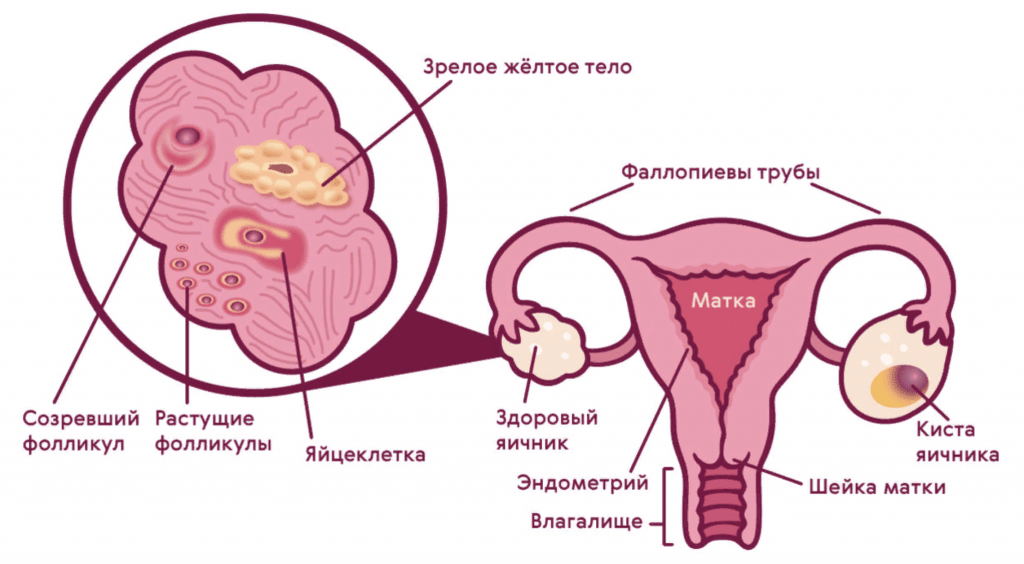 Киста шейки матки: симптомы, диагностика и лечение