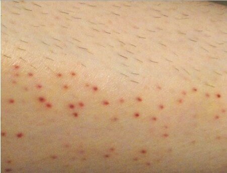 Последствия после электроэпиляции 