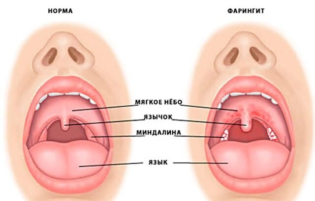 Хронический фарингит у детей