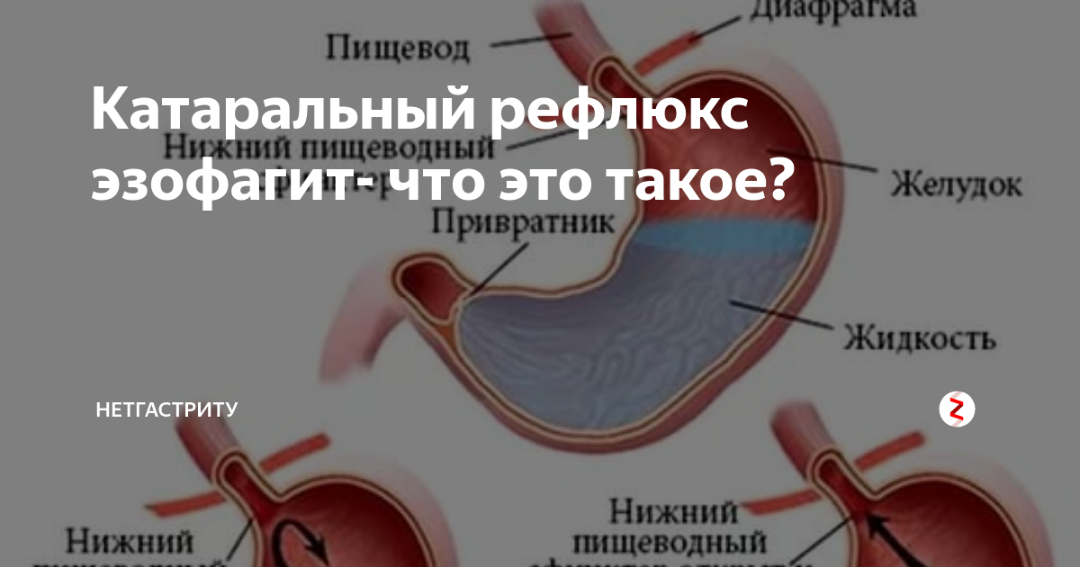 Рефлюкс что это такое. Рефлюксэзофагит дисталтный каторальный. Терминальный рефлюкс эзофагит что это. Дистальный катаральный рефлюкс-эзофагит. Дистальный рефлюкс эзофагит.