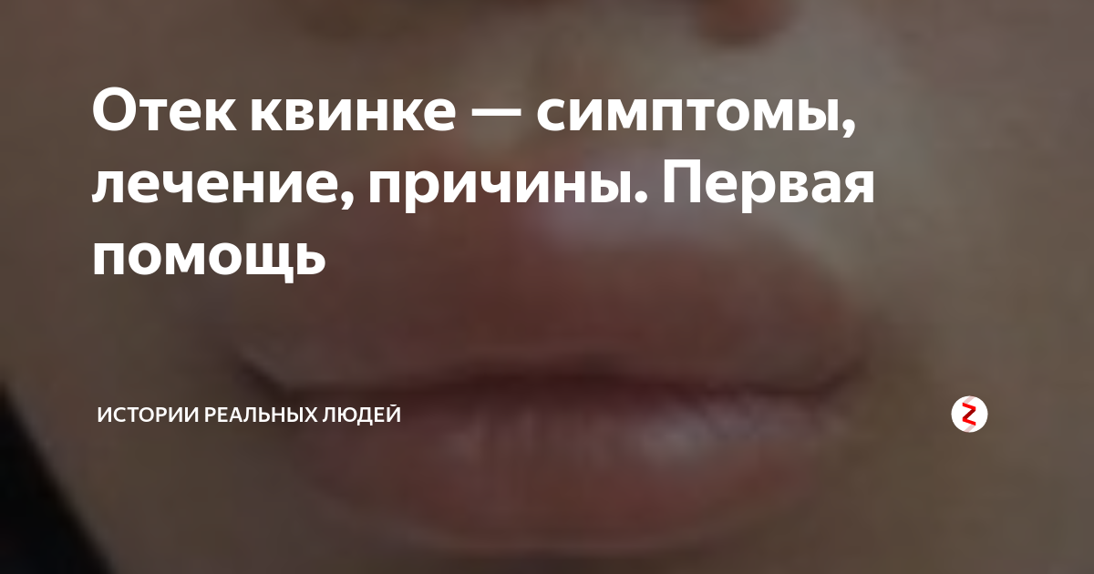 Отек квинке у ребенка первая