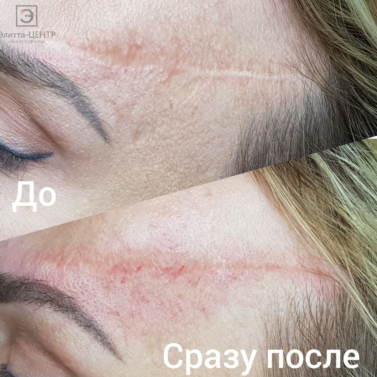 Сейчас хочу рассказать про камуфляж шрамов и рубцов!