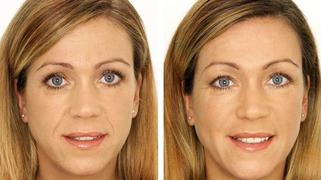 что лучше ботокс или филлеры для лица