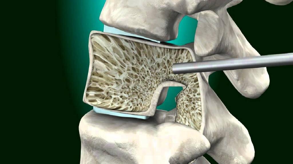 Восстановление позвоночника. Вертебропластика при переломе позвоночника. Чрескожная вертебропластика позвонка что это. Гемангиома вертебропластика. Компрессионный перелом вертебропластика.