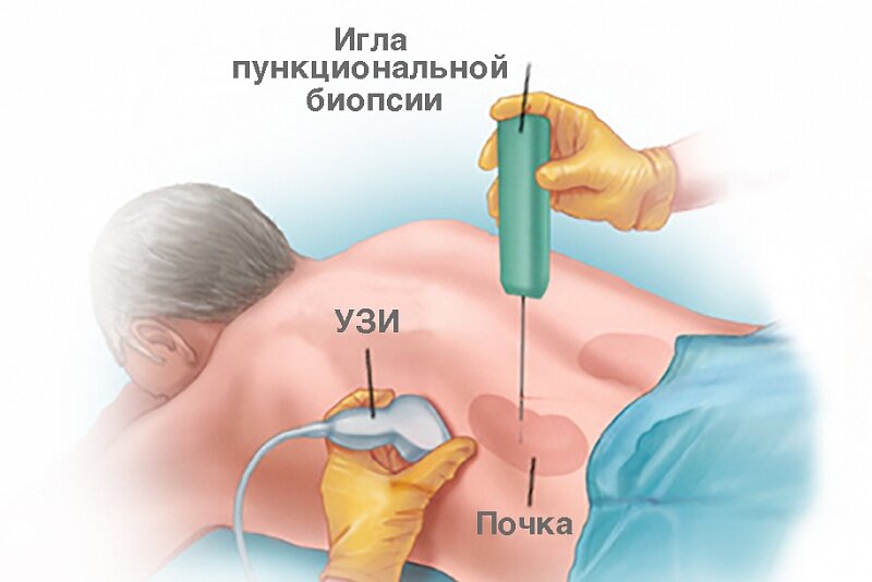 Биопсия почки картинки